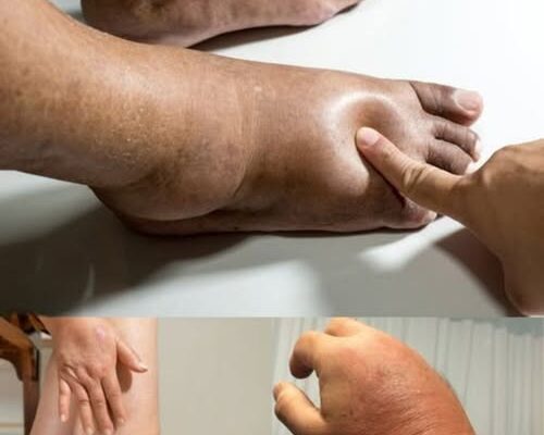 Swollen Hands & Feet?